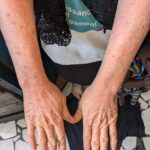Journée internationale de la sensibilisation à l’albinisme, l’association des malades de la peau ECZEMA-RDC alerte sur la situation préoccupante  des personnes atteintes d’albinisme à Goma