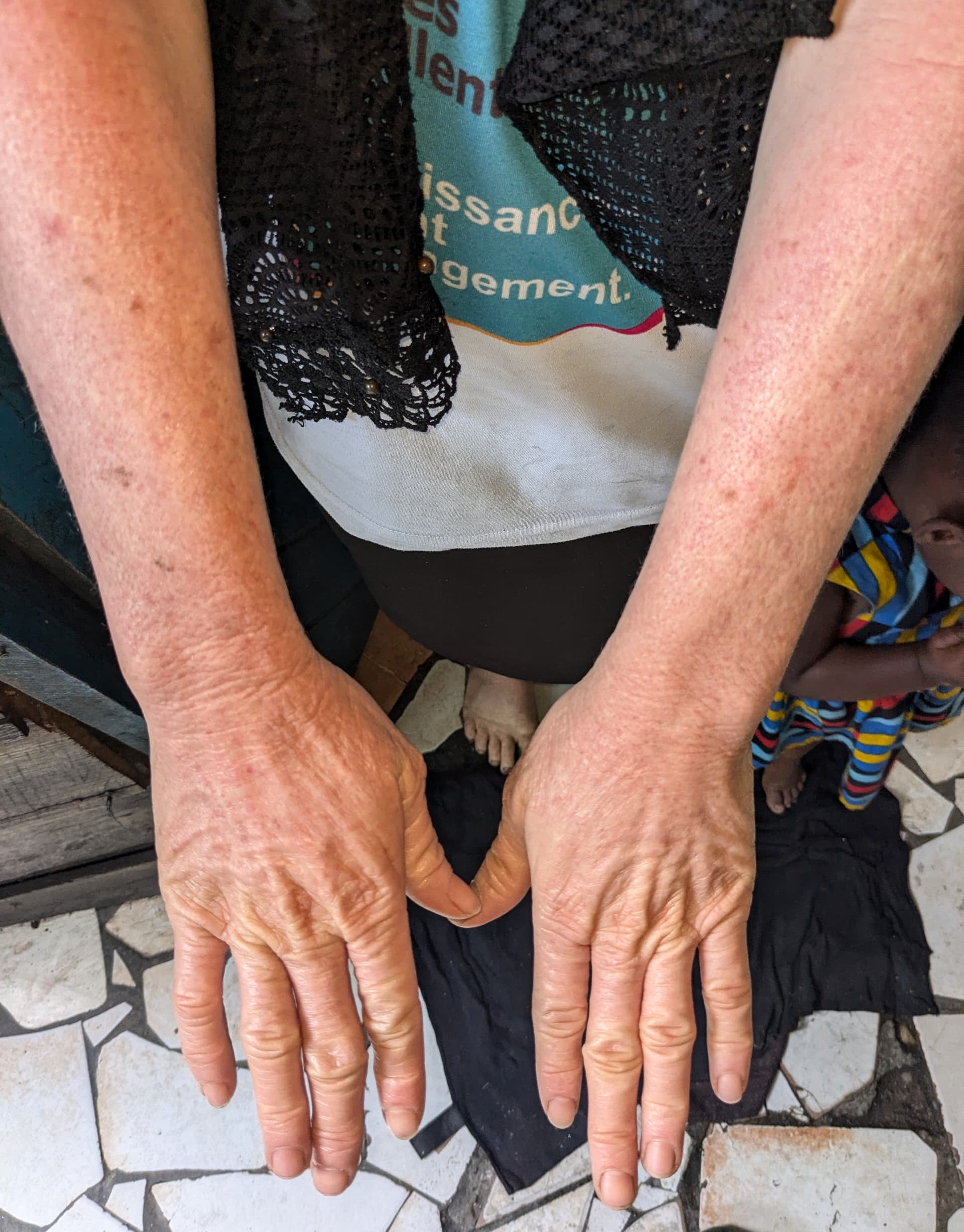 Journée internationale de la sensibilisation à l’albinisme, l’association des malades de la peau ECZEMA-RDC alerte sur la situation préoccupante  des personnes atteintes d’albinisme à Goma